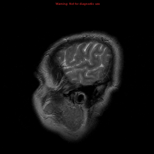 File:Atypical meningioma - grade II (Radiopaedia 13303-13305 Sagittal T2 21).jpg