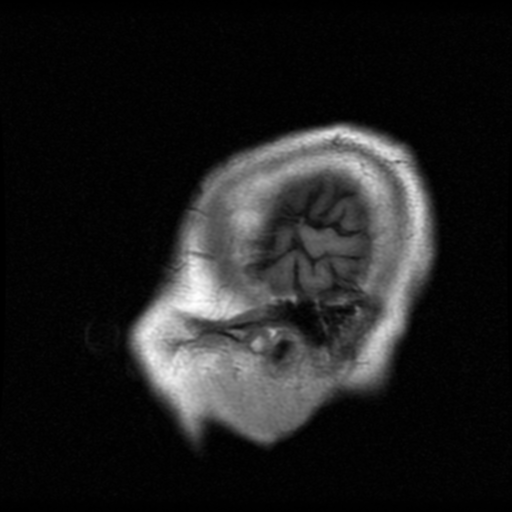 File:Atypical meningioma with skull invasion (Radiopaedia 34357-35648 Sagittal T1 2).png