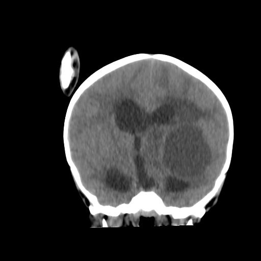 Atypical teratoid rhabdoid tumor (AT-RT) (Radiopaedia 85823-101654 Coronal non-contrast 24).jpg