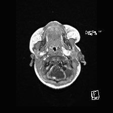 Atypical teratoid rhabdoid tumor (prenatal US and neonatal MRI) (Radiopaedia 59091-66388 Axial T1 C+ 8).jpg