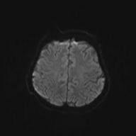 Autoimmune limbic encephalitis (Radiopaedia 30363-31005 Axial B0 and DWI 56).jpg