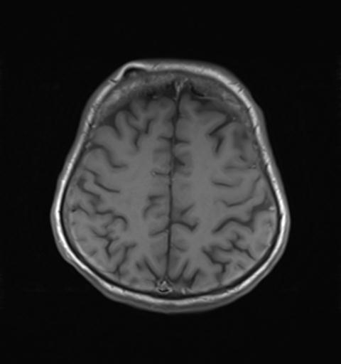 File:Autoimmune limbic encephalitis (Radiopaedia 30363-31005 Axial T1 25).jpg