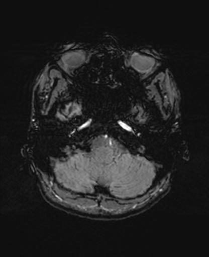 Autoimmune limbic encephalitis (Radiopaedia 30363-31005 SWI 13).jpg