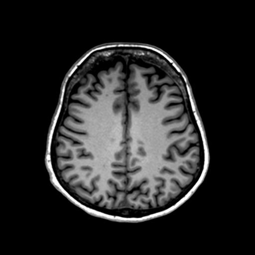 File:Autoimmune limbic encephalitis (Radiopaedia 30363-31005 T1 Axial 1mm 105).jpg