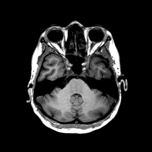 Autoimmune limbic encephalitis (Radiopaedia 30363-31005 T1 Axial 1mm 44).jpg