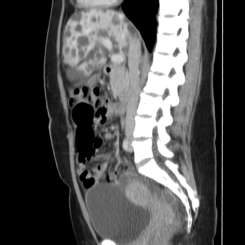 Autosomal dominant polycystic kidney disease (Radiopaedia 23061-23093 F 26).jpg