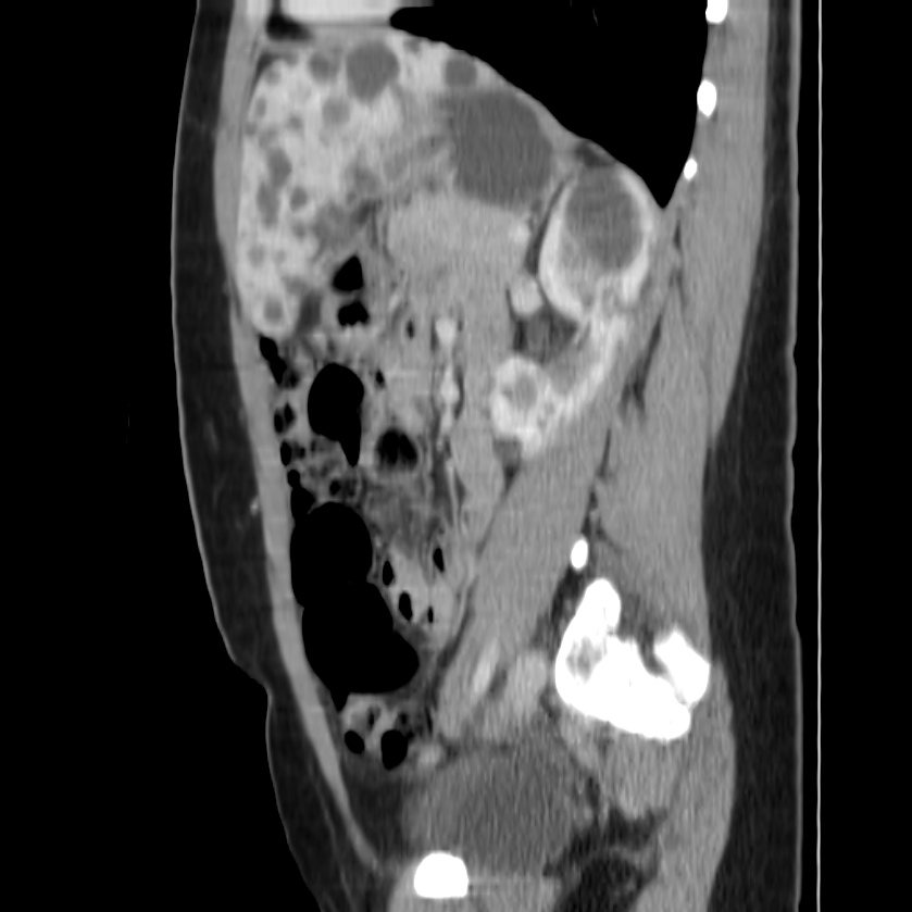 Autosomal dominant polycystic kidney disease (Radiopaedia 23061-23093 F 36).jpg