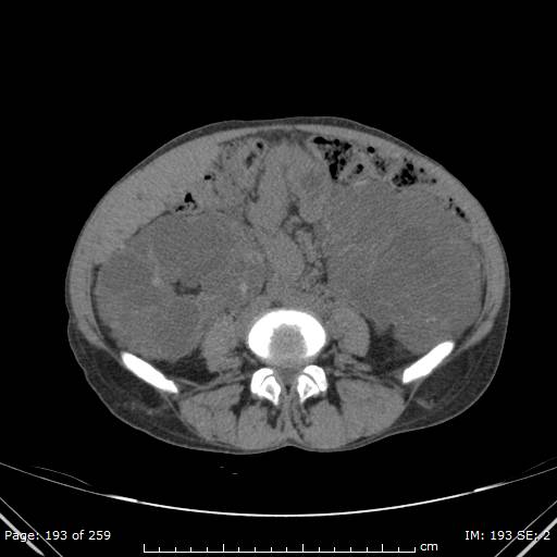 File:Autosomal dominant polycystic kidney disease (Radiopaedia 44122-47684 Axial 44).jpg