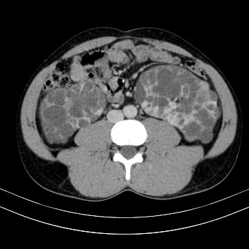 Autosomal dominant polycystic kidney disease (Radiopaedia 66349-75582 B 60).jpg