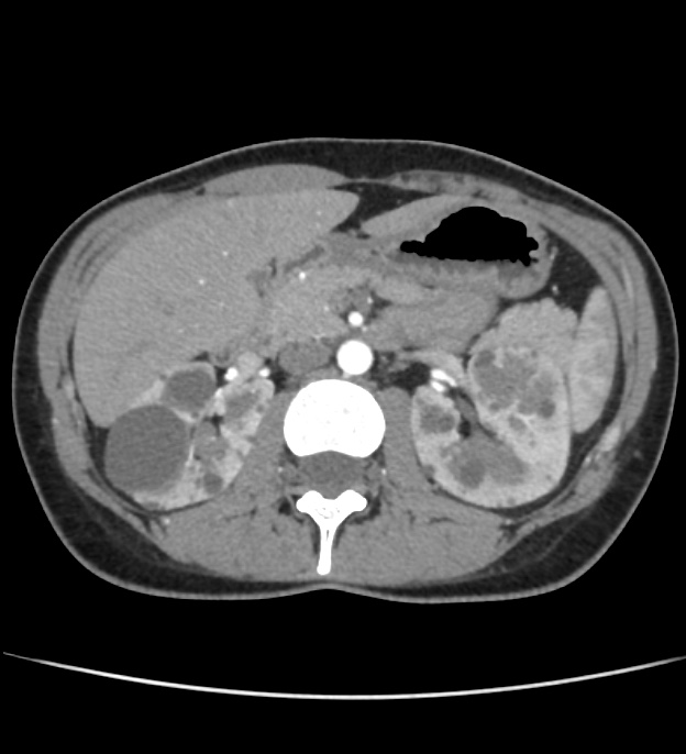 Autosomal dominant polycystic kidney disease - early onset (Radiopaedia 40734-43387 B 19).jpg