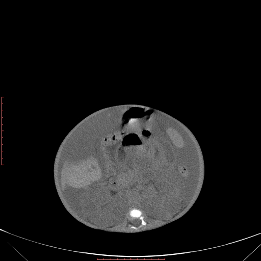 Autosomal recessive polycystic kidney disease associated with Caroli disease (Radiopaedia 61932-69984 Axial non-contrast 209).jpg