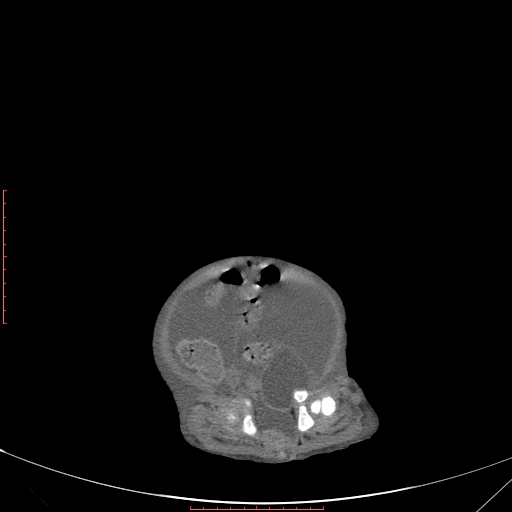 File:Autosomal recessive polycystic kidney disease associated with Caroli disease (Radiopaedia 61932-69984 B 330).jpg