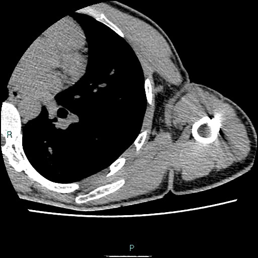 File:Avascular necrosis after fracture dislocations of the proximal humerus (Radiopaedia 88078-104653 D 77).jpg