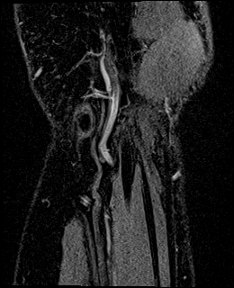 Avascular necrosis of the capitate (Radiopaedia 88317-104948 Coronal T1 vibe 82).jpg