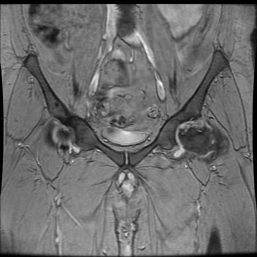 Avascular necrosis of the hip (Radiopaedia 61503-69465 F 28).jpg