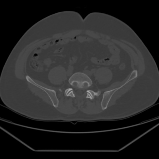 File:Avascular necrosis of the hip (Radiopaedia 61503-69467 Axial bone window 6).jpg