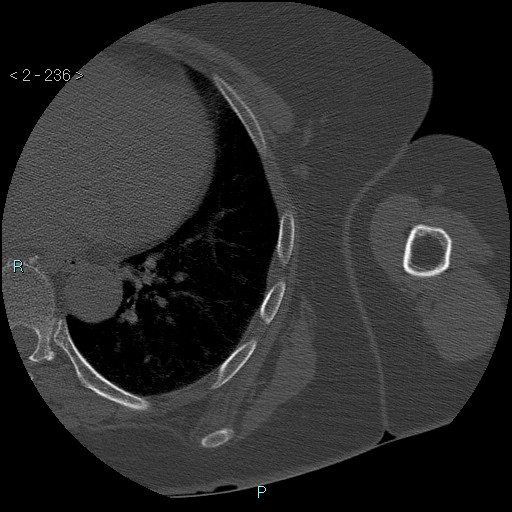 File:Avascular necrosis of the shoulder - Cruess stage I (Radiopaedia 77674-89887 Axial bone window 59).jpg
