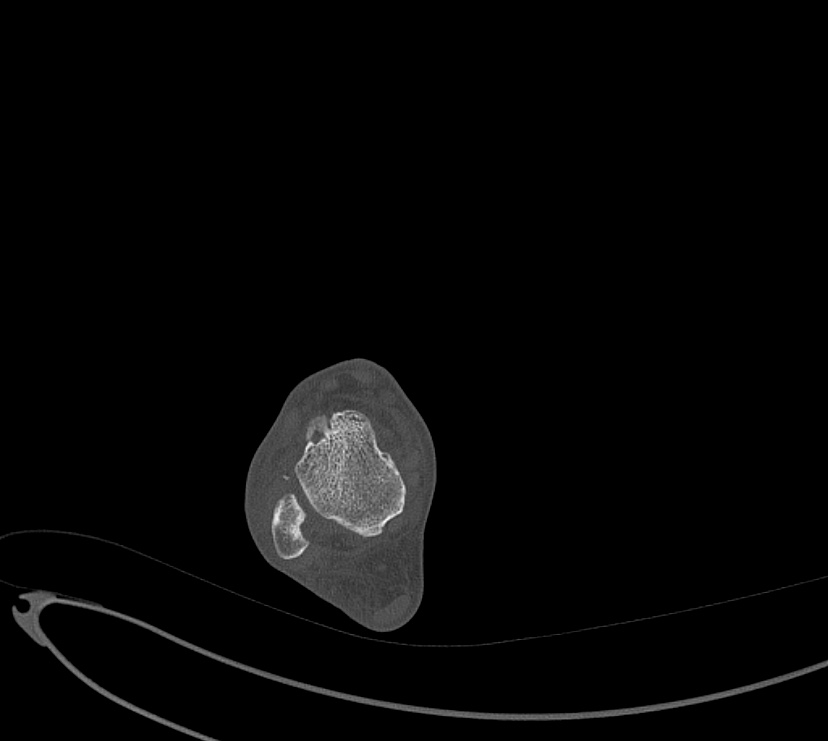 Avulsion fractures of talus and calcaneus (Radiopaedia 48277-53155 Axial bone window 17).jpg
