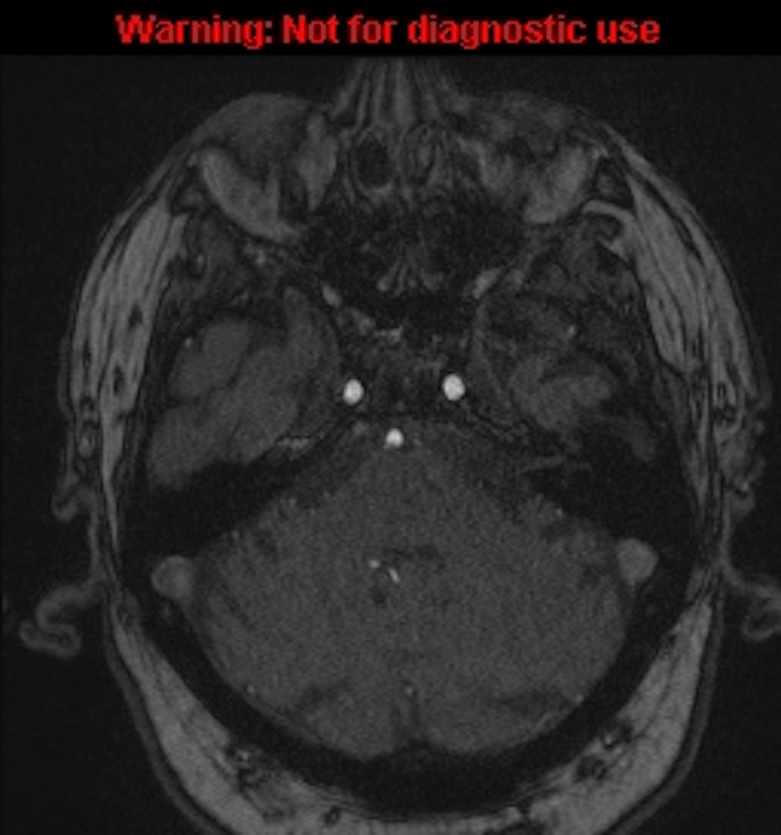 Azygos anterior cerebral artery (Radiopaedia 59325-66677 Axial MRA 37).jpg
