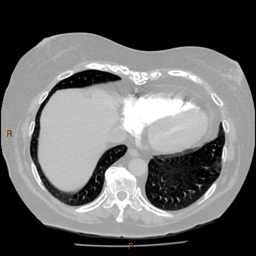 Azygos lobe (Radiopaedia 40161-42821 Axial lung window 58).jpg