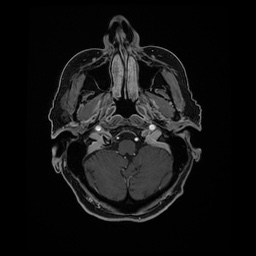 Balo concentric sclerosis (Radiopaedia 53875-59982 Axial LAVA C+ 44).jpg