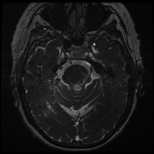 File:Balo concentric sclerosis (Radiopaedia 53875-59982 Axial T2 FIESTA 57).jpg
