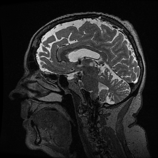 Balo concentric sclerosis (Radiopaedia 53875-59982 Sagittal 3D FSE 132).jpg
