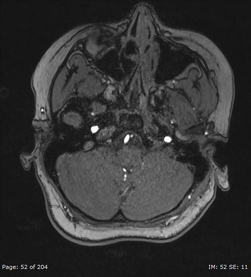 Balo concentric sclerosis (Radiopaedia 61637-69636 Axial MRA 52).jpg