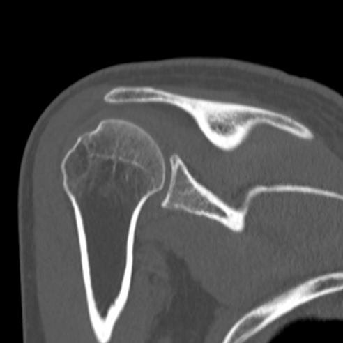 Bankart lesion (Radiopaedia 57256-64185 Coronal bone window 31).jpg