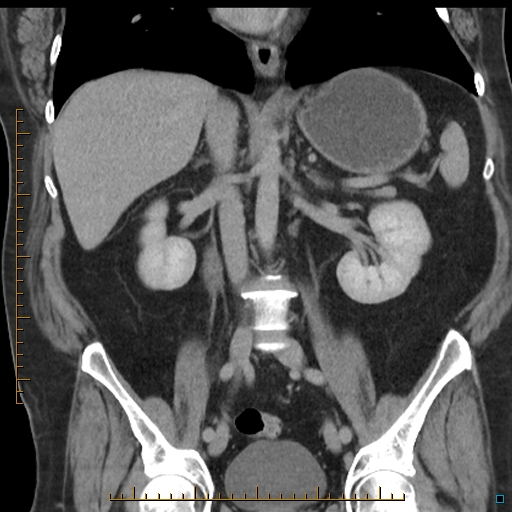 File:Bariatric balloon causing gastric outlet obstruction (Radiopaedia 54449-60672 B 34).jpg