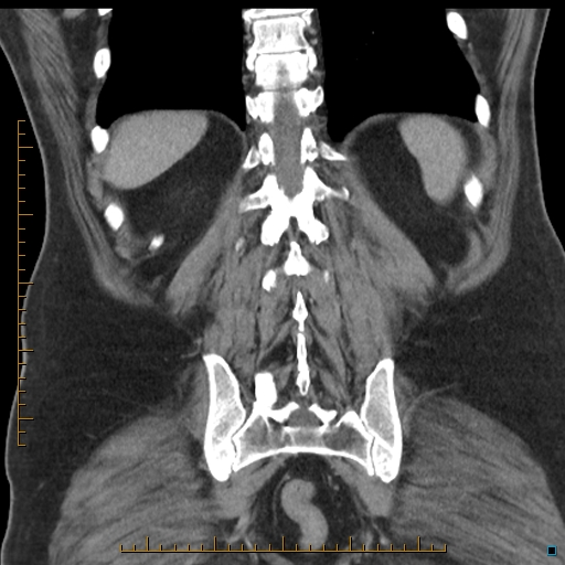 File:Bariatric balloon causing gastric outlet obstruction (Radiopaedia 54449-60672 B 48).jpg