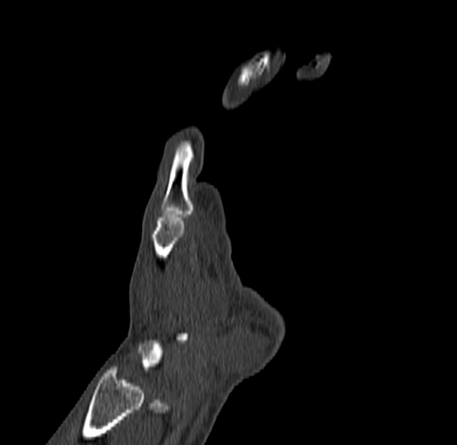 Base of 2nd metacarpal fracture (Radiopaedia 73741-84544 Coronal bone window 25).jpg