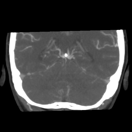 File:Basilar artery fenestration and aneurysms with subarachnoid hemorrhage (Radiopaedia 40066-42573 B 39).png