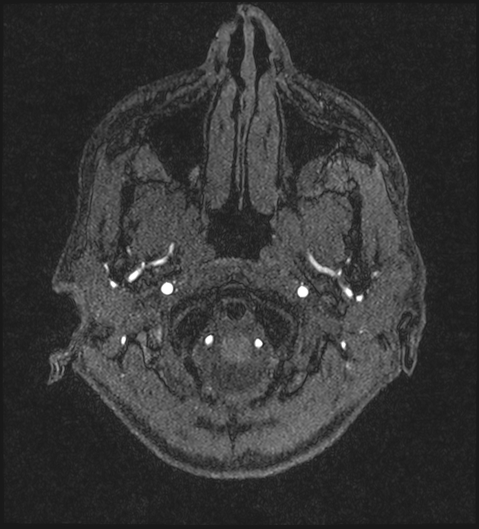 Basilar artery perforator aneurysm (Radiopaedia 82455-97733 Axial MRA 14).jpg