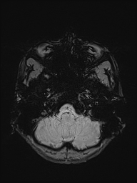 File:Basilar artery perforator aneurysm (Radiopaedia 82455-97733 Axial SWI 6).jpg