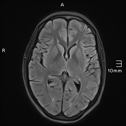 File:Basilar artery perforator aneurysm (Radiopaedia 82455-99523 Axial FLAIR 12).jpg