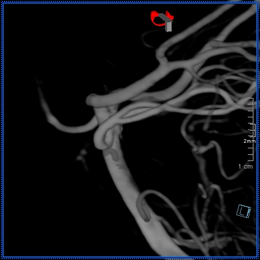 File:Basilar artery perforator aneurysm (Radiopaedia 82455-99524 3D Left VA 18).jpg