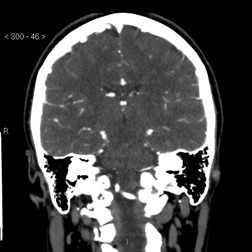 Basilar artery thrombosis (Radiopaedia 16260-15944 B 37).jpg