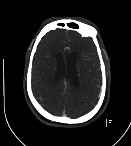 File:Basilar artery thrombosis (Radiopaedia 26986-27163 A 58).jpg