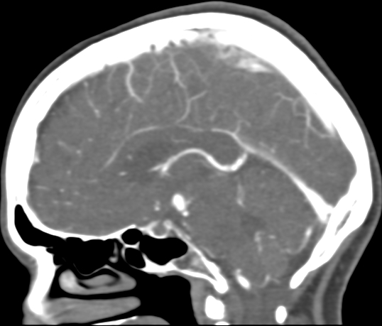 Basilar tip aneurysm with coiling (Radiopaedia 53912-60086 C 70).jpg