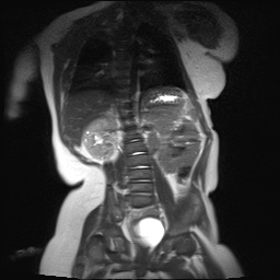 File:Beckwith-Wiedeman syndrome with bilateral Wilms tumors (Radiopaedia 60850-69233 B 10).jpg