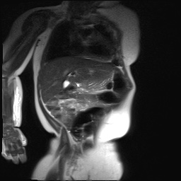 File:Beckwith-Wiedeman syndrome with bilateral Wilms tumors (Radiopaedia 60850-69233 B 19).jpg