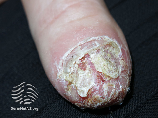 File:Before treatment (DermNet NZ scaly-acropustulosis-01).jpg