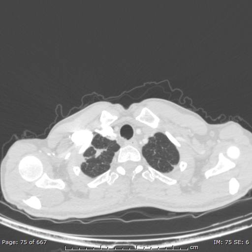 Behçet disease (Radiopaedia 44247-47889 Axial lung window 4).jpg