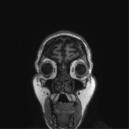 File:Behavioral variant frontotemporal dementia and late onset schizophrenia (Radiopaedia 52197-58083 Coronal T1 82).png