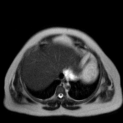 File:Benign seromucinous cystadenoma of the ovary (Radiopaedia 71065-81300 Axial T2 21).jpg