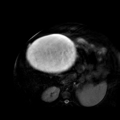 File:Benign seromucinous cystadenoma of the ovary (Radiopaedia 71065-81300 T2 SPAIR 33).jpg