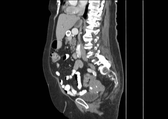 File:Bicameral celiacomesenteric aneurysm (Radiopaedia 55766-62327 B 27).jpg