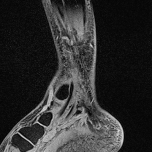 Bilateral Achilles tendon complete tear (Radiopaedia 81344-95051 Sagittal WE - Left 31).jpg