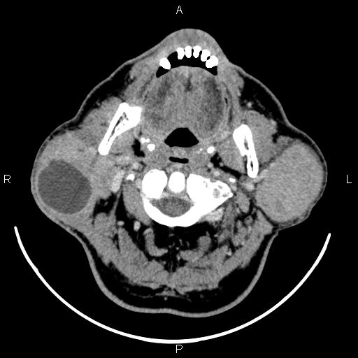 Bilateral Warthin tumors (Radiopaedia 84034-99263 Axial With contrast 22).jpg